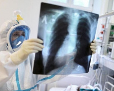 53 пацієнти госпіталізовано з пневмонією у Кривому Розі