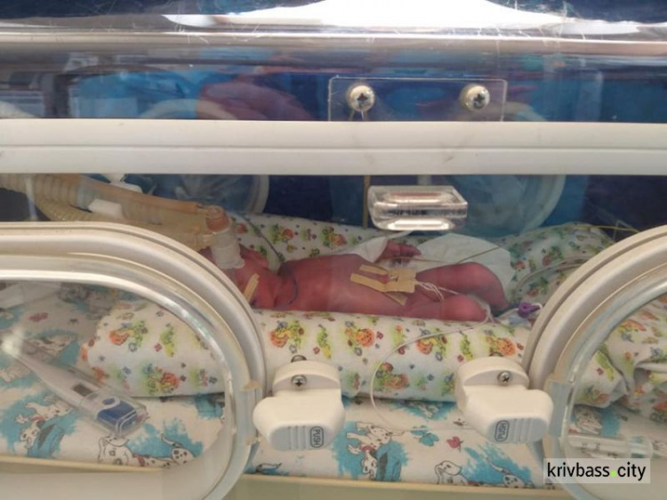 В Днепре спасают маленьких криворожанок, которые родились весом 740 и 900 грамм
