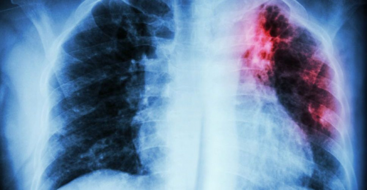 В Кривом Роге проживает 1015 человек, больных туберкулёзом, – врачи