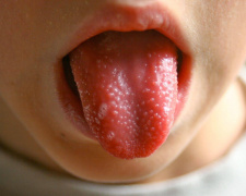 Скарлатина у Кривому Розі, фото з відкритих джерел