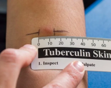 Проба Манту, фото з відкритих джерел