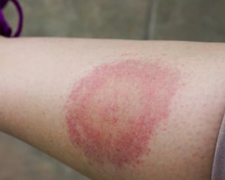 Хвороба Лайма, фото з відкритих джерел 