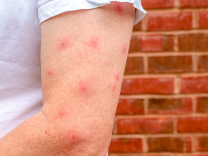 Укуси мокреців, фото з відкритих джерел 