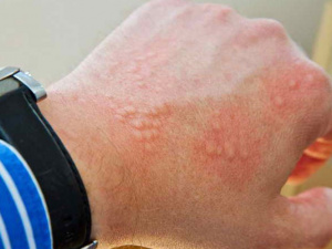 Що таке Холодова алергія? Криворізький дитячий лікар пояснює (КОРИСНО)