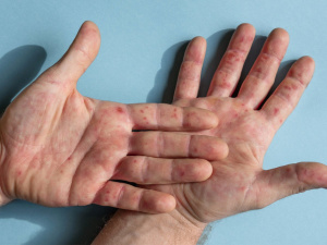 У МОЗ не будуть розголошувати інформацію про поширення мавпячої віспи - заява