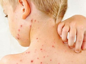 Чи загрожує країні спалах кору – роз’яснення від МОЗ