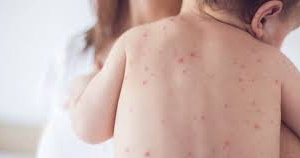 Криворіжцям нагадали, як полегшити свербіж при вітрянці? (КОРИСНО)