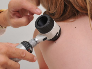 У Кривому Розі лікарі перевірять родимки: як записатись на дерматоскопію