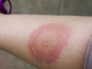 Хвороба Лайма, фото з відкритих джерел 