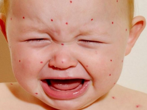 Корь не отступает: более 80 жителей Днепропетровщины заболели за последнюю неделю