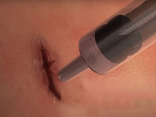 Учёные создали хирургический гель  стягивающий рану за 1 минуту