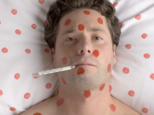 Новая вспышка кори: 60% заболевших криворожан - взрослые