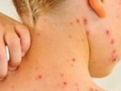 На Днепропетровщине зафиксировали более 170 случаев заболевания корью