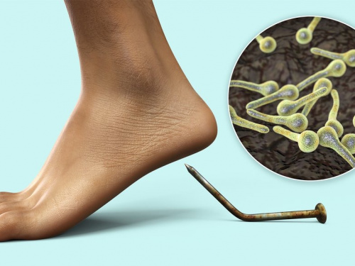 Вакцина могла врятувати: на Дніпропетровщині дитина померла від правця