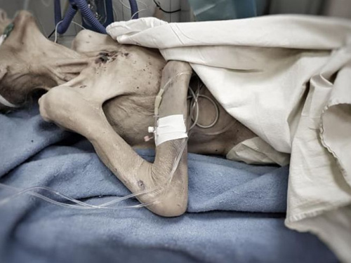 Узник Бухенвальда: в Днепропетровской области сын довел родную мать до ужасного истощения (фото 18+)