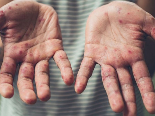 В Днепропетровской области зарегистрирована вспышка кори, - Центр гражданского здоровья