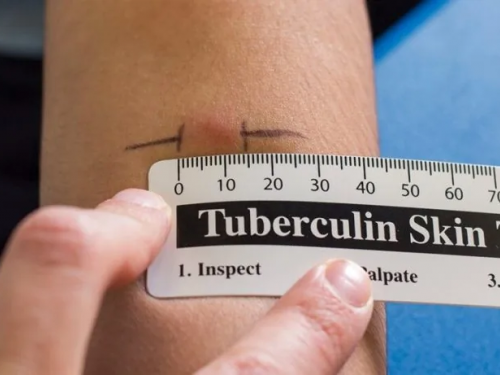 Проба Манту, фото з відкритих джерел