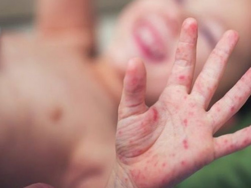 В Кривом Роге вспышка кори: зафиксирован летальный случай