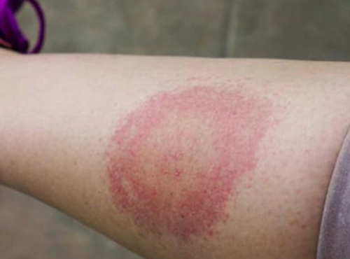 Хвороба Лайма, фото з відкритих джерел 