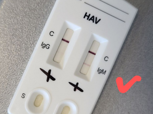 Вже у Кривому Розі: випадок гепатиту А зафіксували лікарі приватної клініки