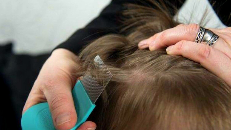 Воші, педикульоз, фото з відкритих джерел