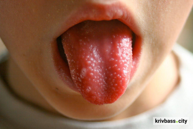 Скарлатина у Кривому Розі: як захиститися від небезпечної інфекції