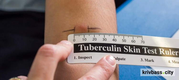 Проба Манту, фото з відкритих джерел