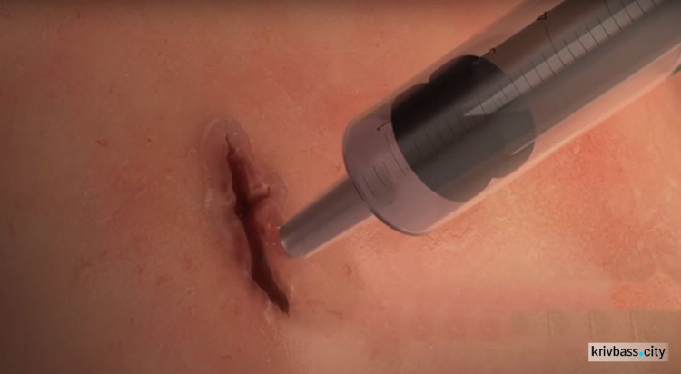 Учёные создали хирургический гель  стягивающий рану за 1 минуту