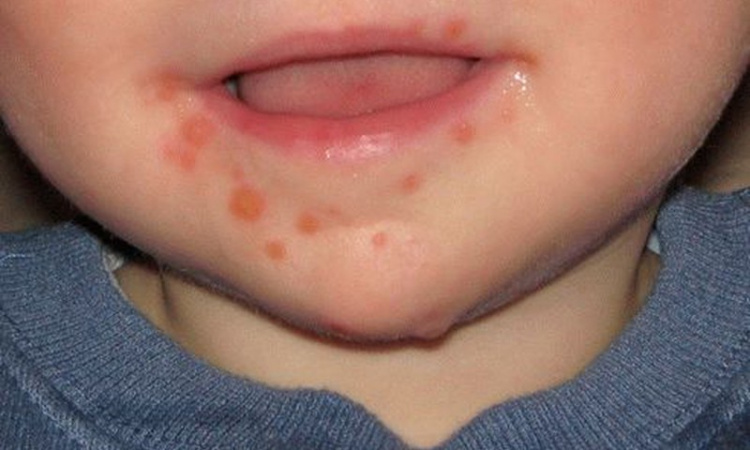 Симптоми вірусу Коксакі - фото ілюстративне з відкритих джерел