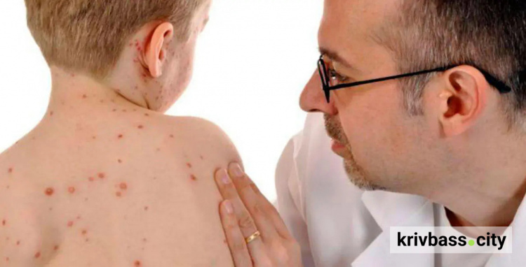 Профілактика корі, фото ілюстративне 