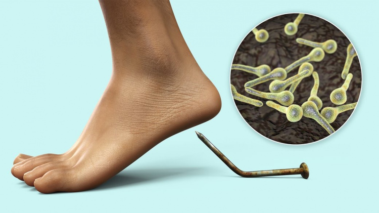 Вакцина могла врятувати: на Дніпропетровщині дитина померла від правця